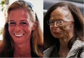 O QUE O ÁCIDO FEZ COM ELA.PROCURE  SABER MAIS. A HISTÓRIA DAS MULHERES...